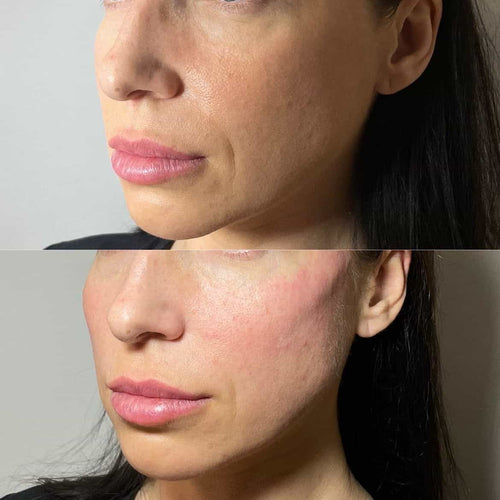 What Is The Best Thing To Put On Lips After Fillers?