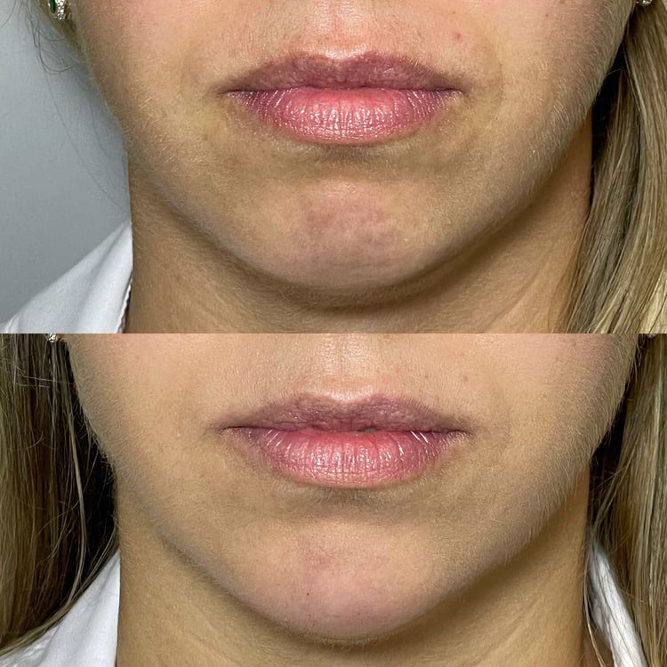 Botox For Downturned Mouth in Chobham, Surrey