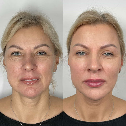 Can You Fix Sagging Jowls Without Surgery?