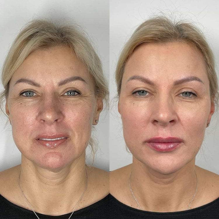 What is a non-surgical liquid facelift and how does it work
