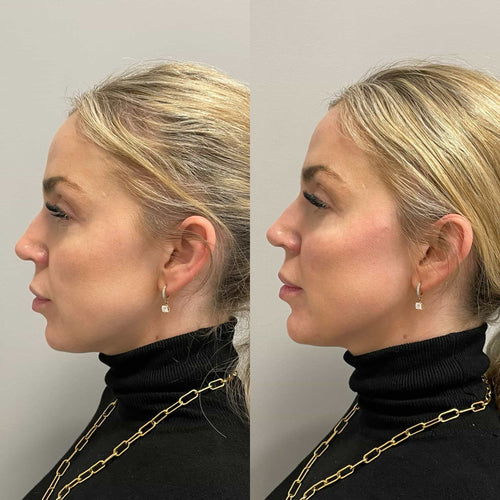 Can You Fix Sagging Jowls Without Surgery?