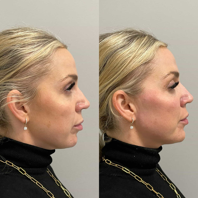 What is a non-surgical liquid facelift and how does it work