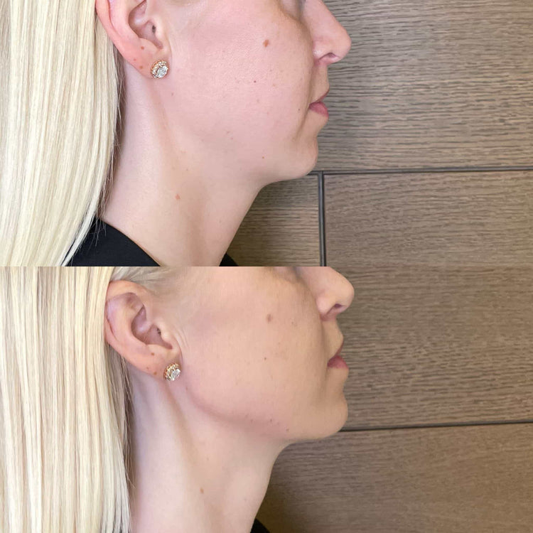 Cheek-Jawline Transition Filler in Frimley, Surrey