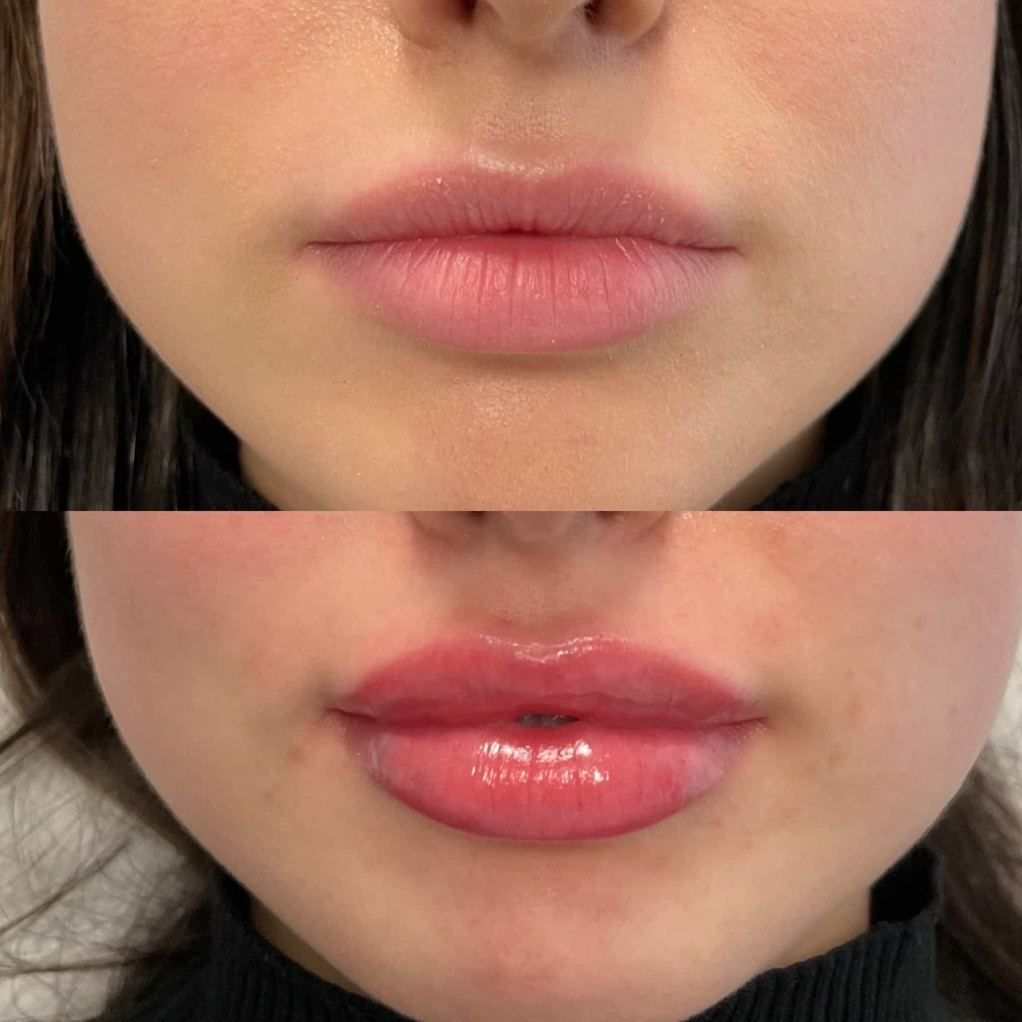 What Are the Benefits of Lip Flip Treatment Compared to Lip Fillers