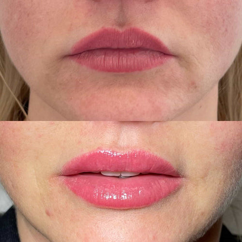 Why Does Lip Filler Migrate
