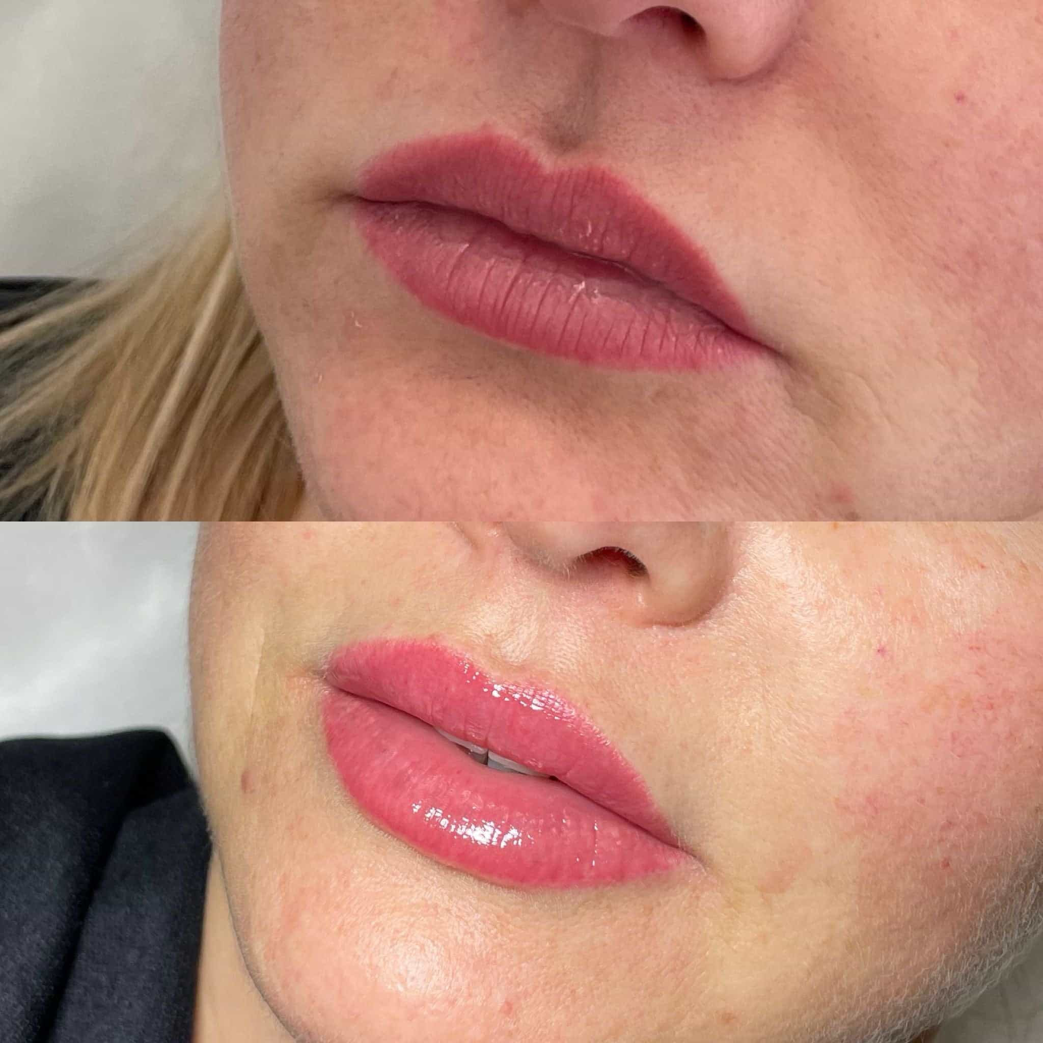 What Are the Benefits of Lip Flip Treatment Compared to Lip Fillers