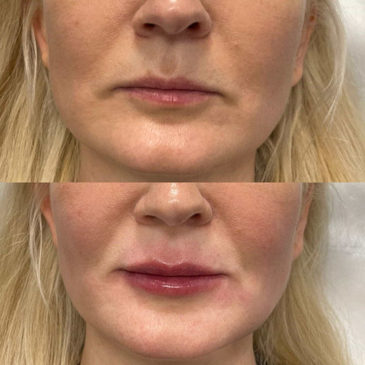 Midface Volume Restoration in Warlingham, Surrey