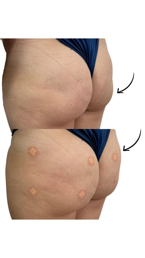 Bum Filler Injections in Surbiton Surrey