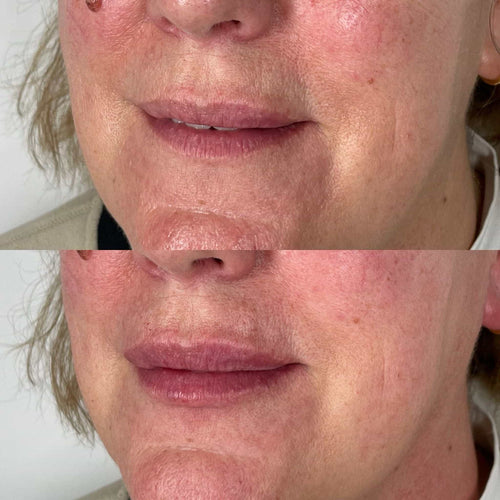 How Long Does Lip Filler Take To Work