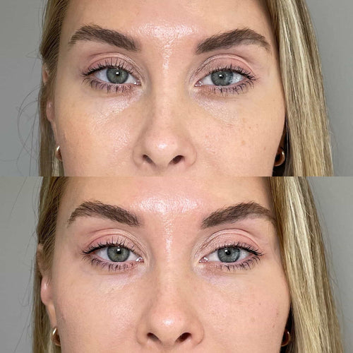 What is an 8 point liquid facelift?