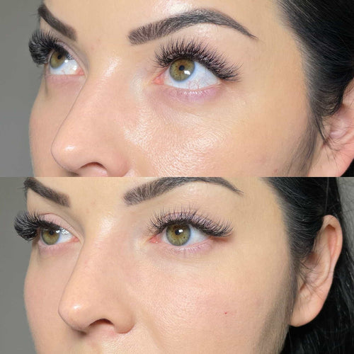 What is the safest filler for tear trough?