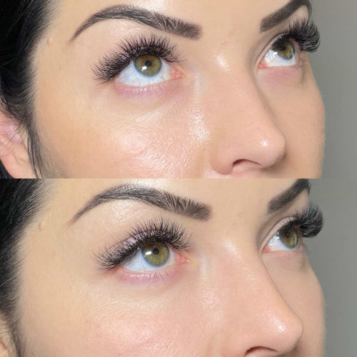 What is the safest filler for tear trough?